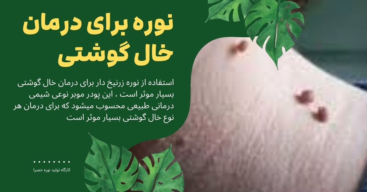 درمان خال گوشتی